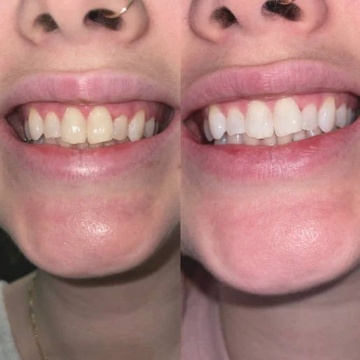 Laura — Antes y Después de V34